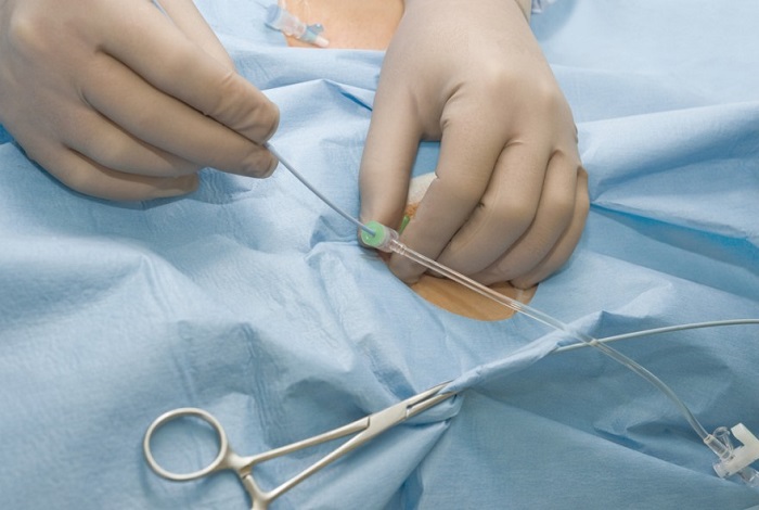 Urine Catheter Insertion At Home In Lajpat Nagar